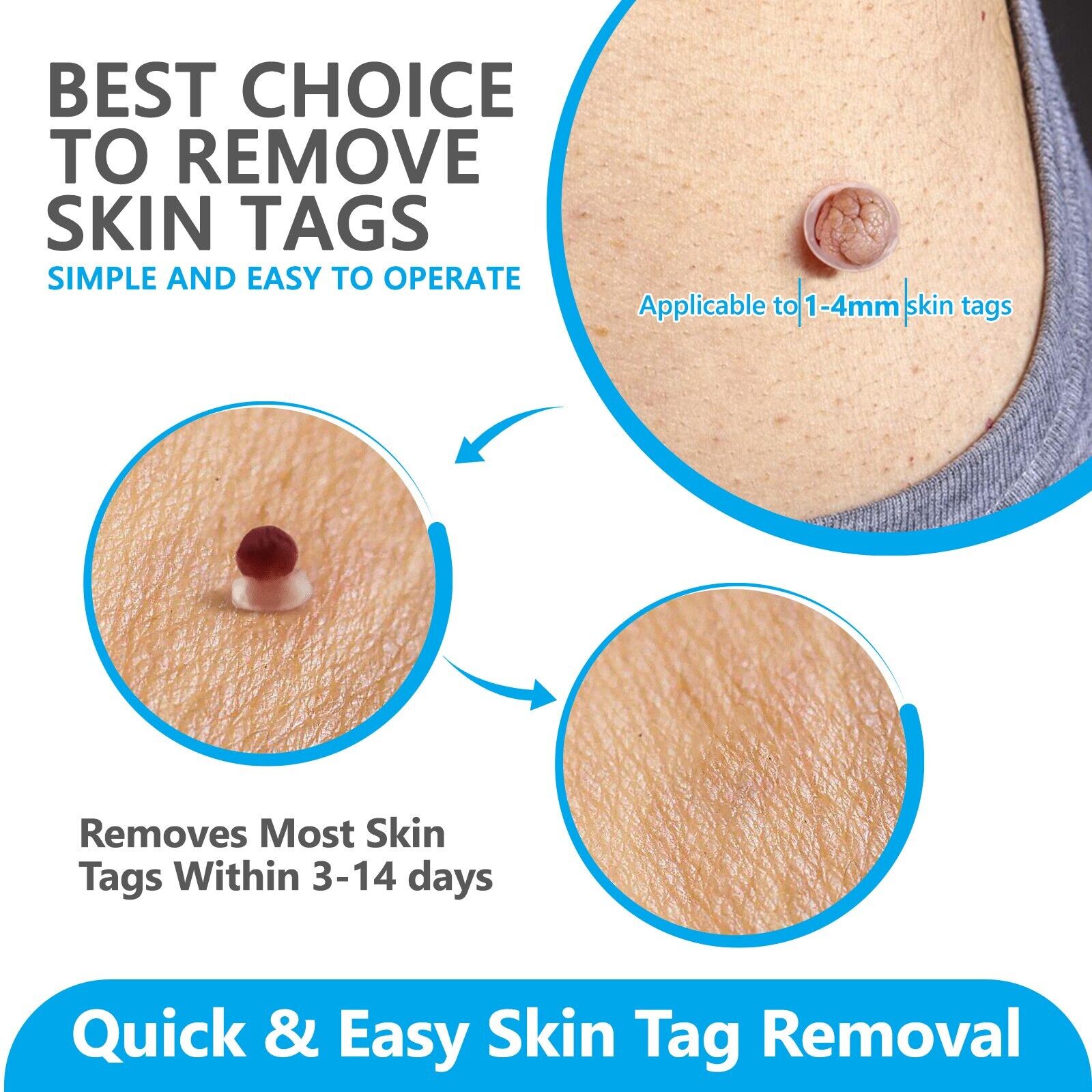 #1 NEW SKIN TAG REMOVAL KIT PAINLESS REMOVER FAST EASY SAFE MOLE WART SPOT TAGS